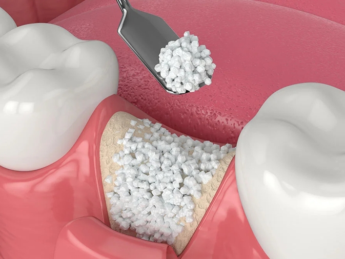 Bone Grafting