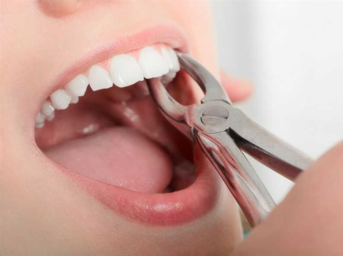 Dental Extraction