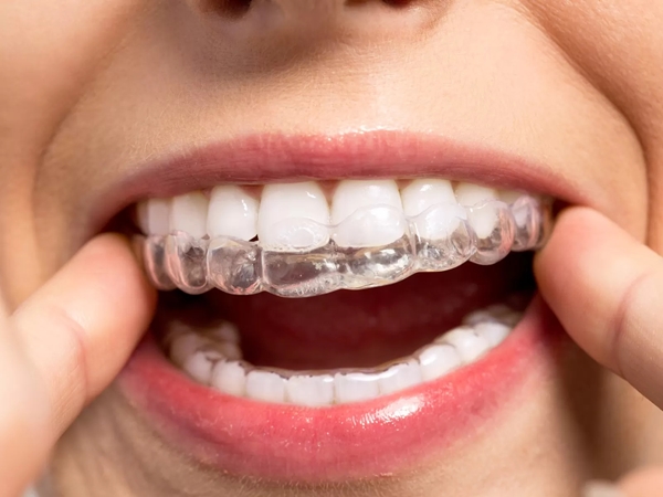 Invisalign