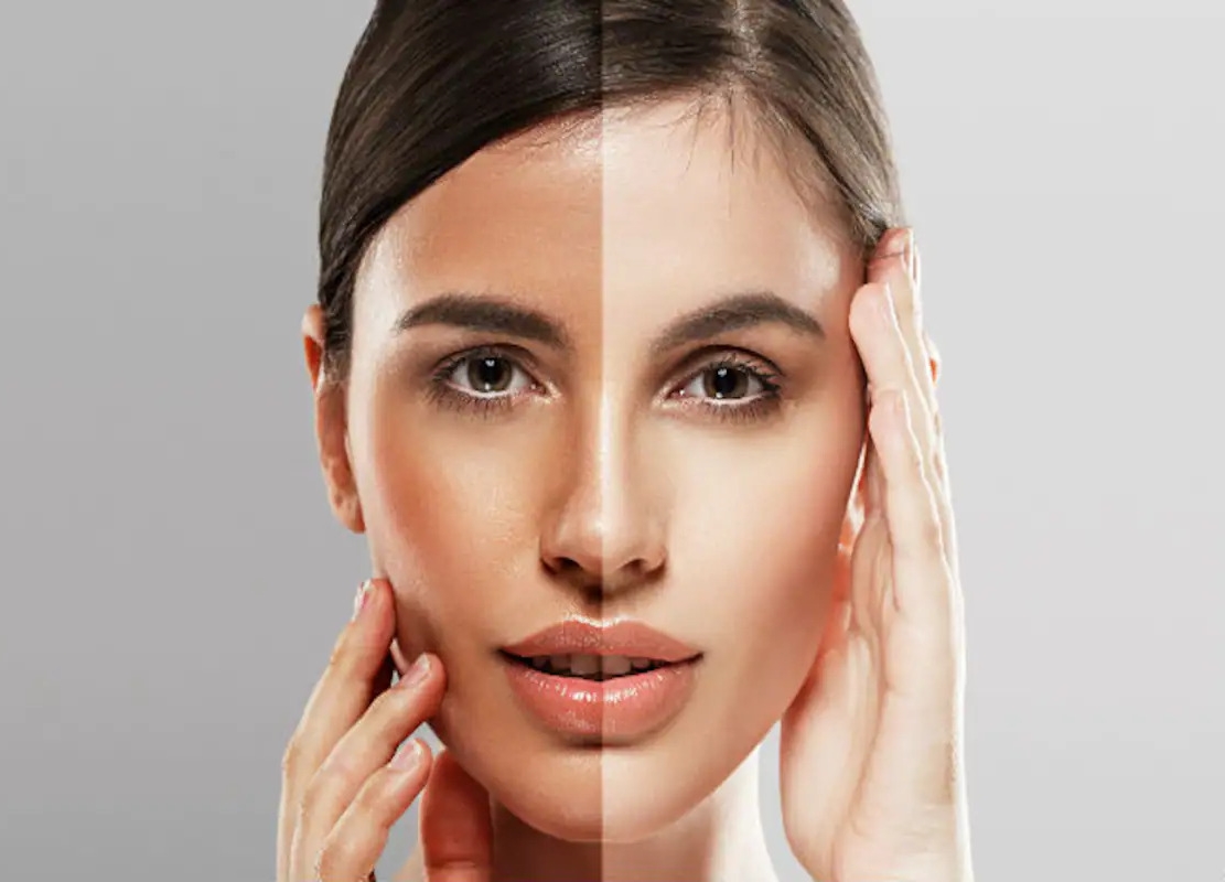 Skin Whitening