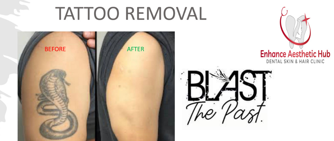 Tattoo Removal