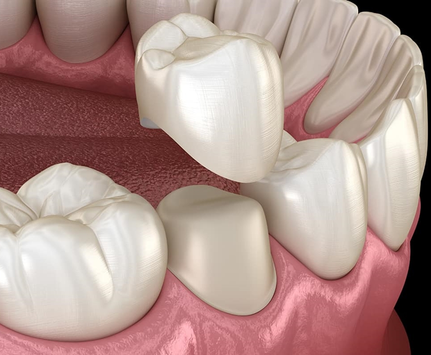 Dental Crowns