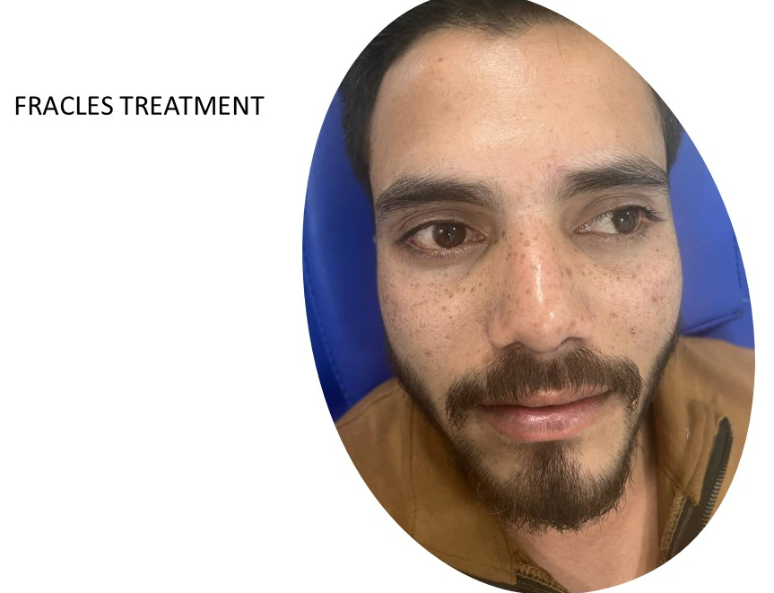 Scar Removal