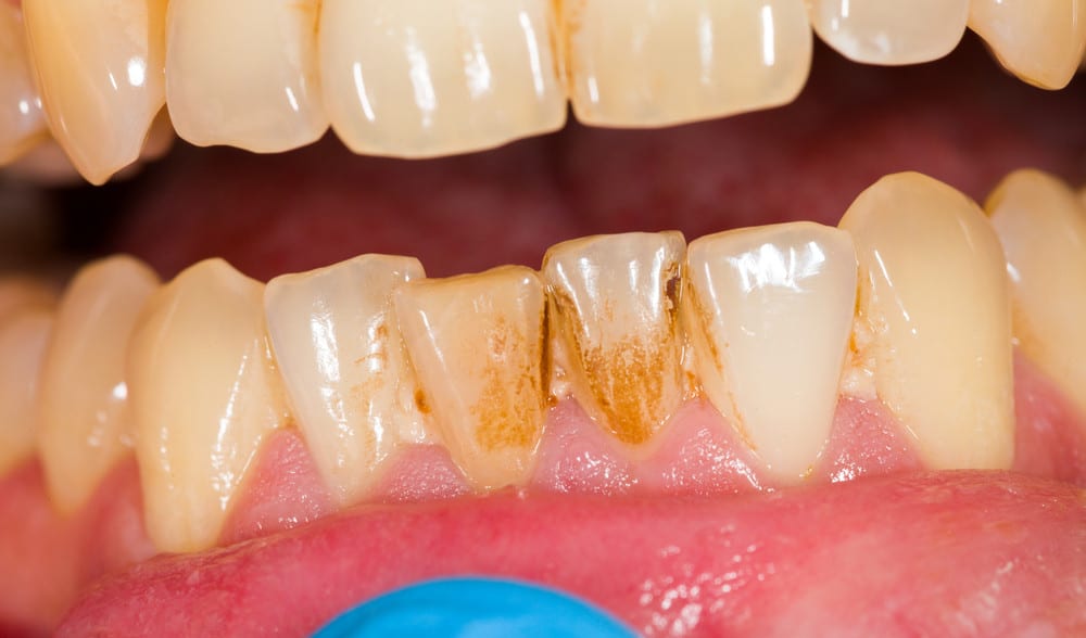 What is dental plaque and How can I get rid of it